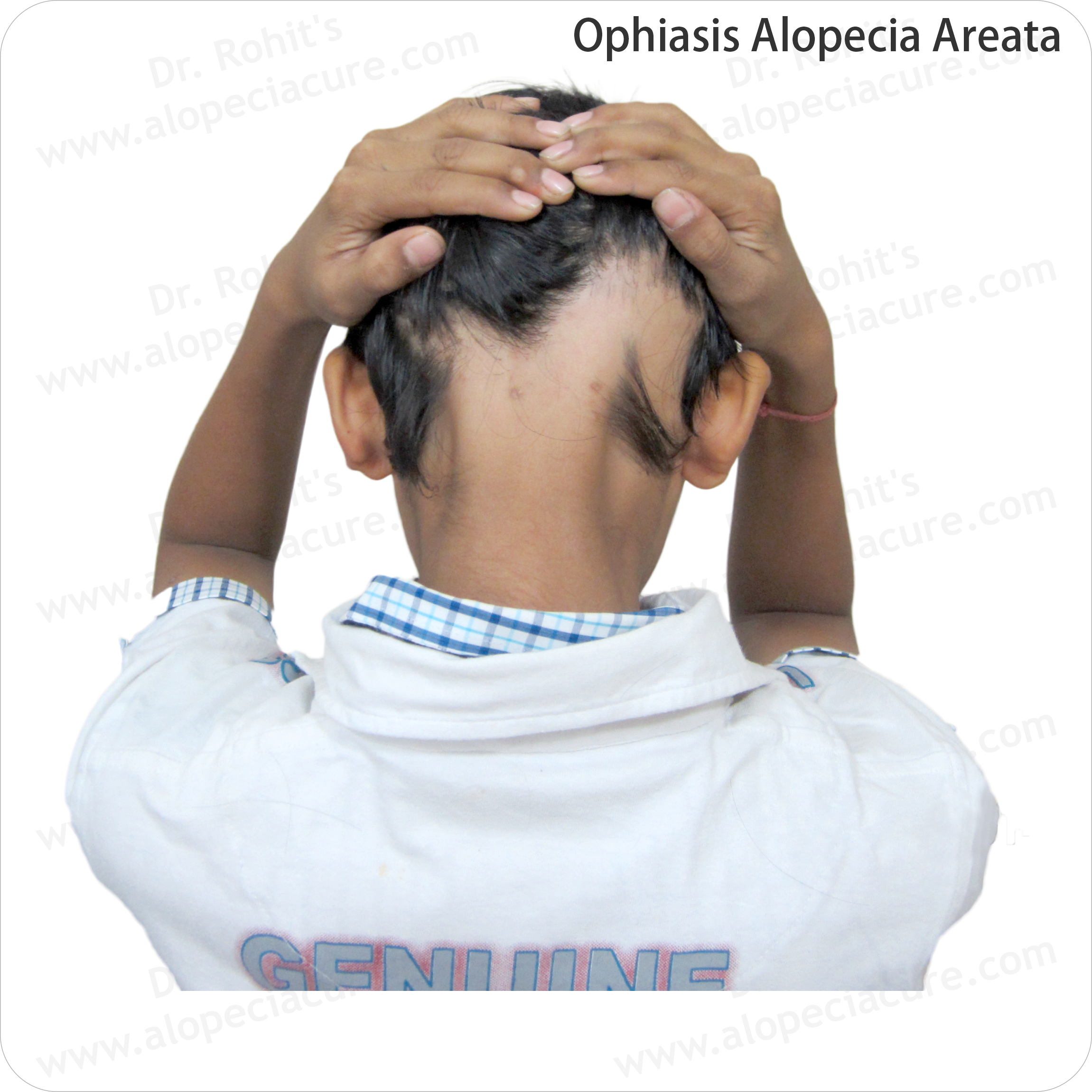 Alopecia Result